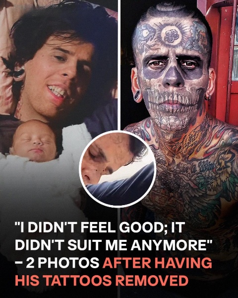 A Man Once Known for Having the Most Tattoos in Brazil Reveals His Shocking Transformation After Removing Them — The AFTER Photos