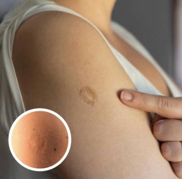 Here Is The Truth Behind This Scar On Peoples Upper Left Arm!