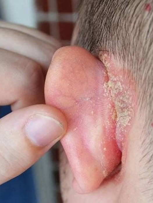Caring for Your Child’s Ear: Understanding and Managing Unusual Skin Changes