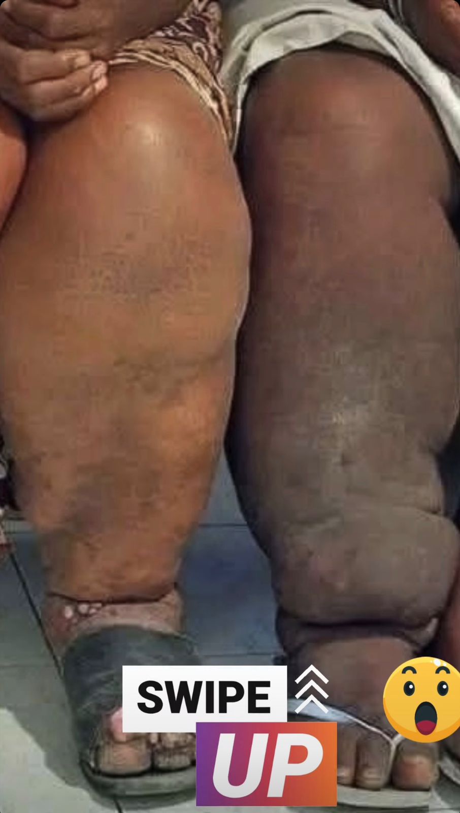 The Consequences of Lymphatic Filariasis Are No Less Severe Than Dengue Fever